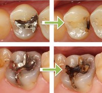 二次カリエス（インレー）.jpg